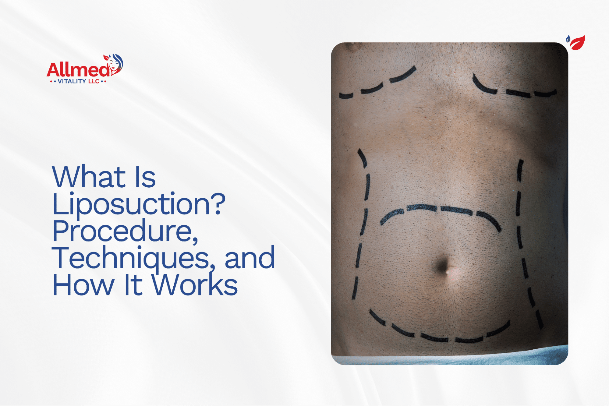 What Is Liposuction? Procedure, Techniques, and How It Works